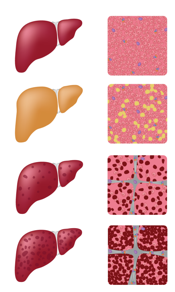 CALIBRA - VD -www - Hepatic - 6-21 - 4